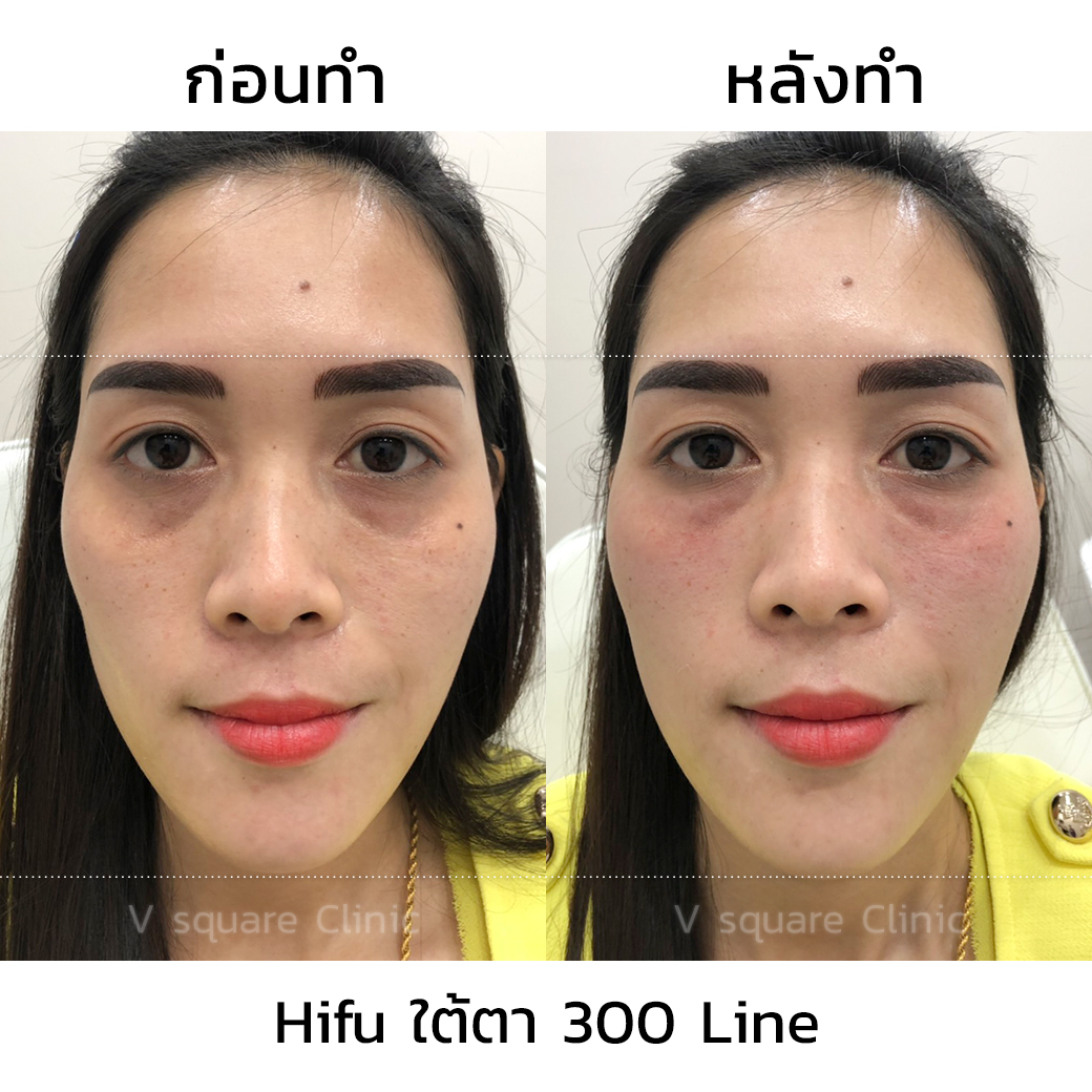 Bangkok HIFU under-eye review_รหัสงานR0077