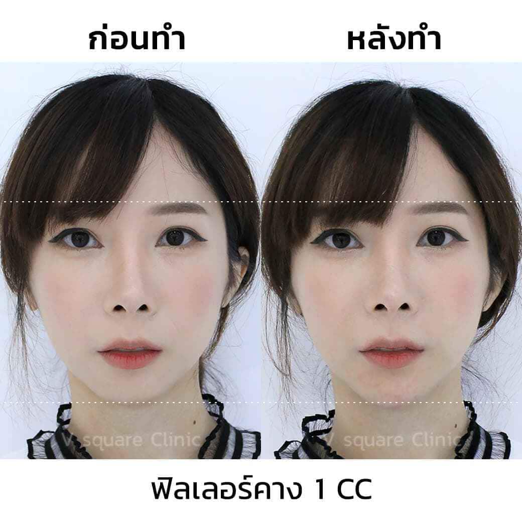 Chin Filler Review_ภาพพิมพ์