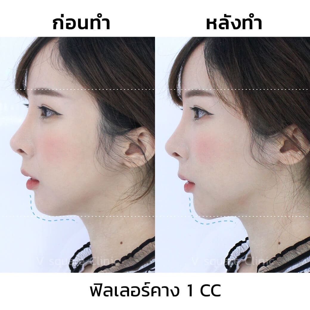 Chin Filler Review_ภาพพิมพ์