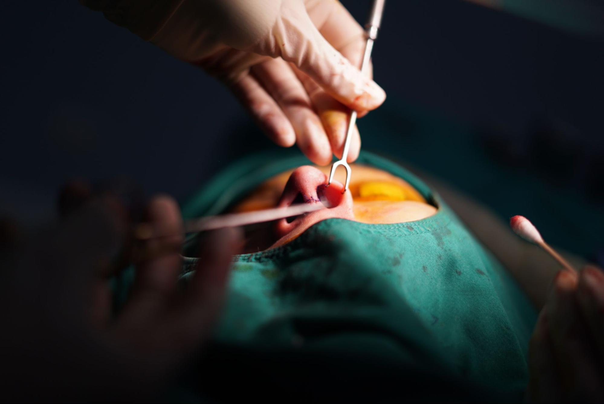 Closed rhinoplasty incision technique