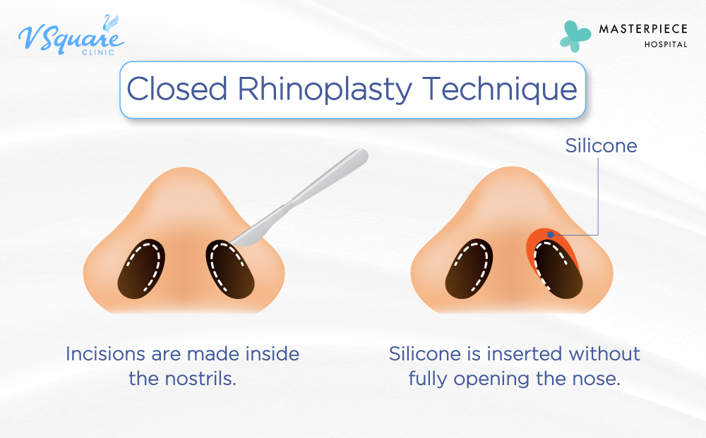 Closed rhinoplasty technique