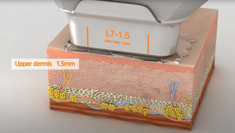 HIFU cartridge 1.5–2.0 mm