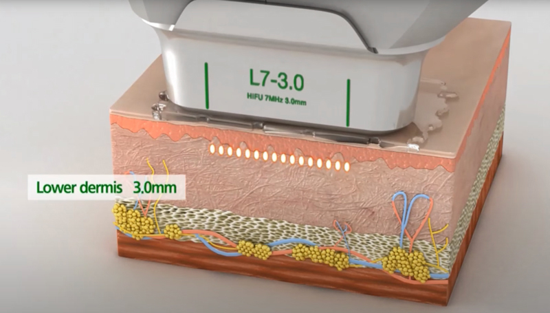 HIFU cartridge 3.0 mm