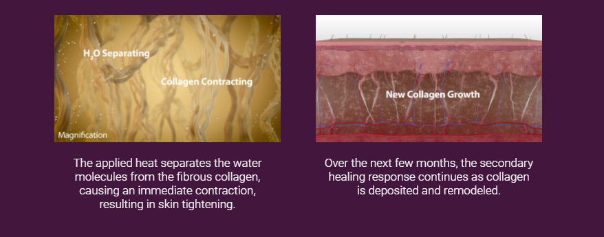 How Thermage tightens skin