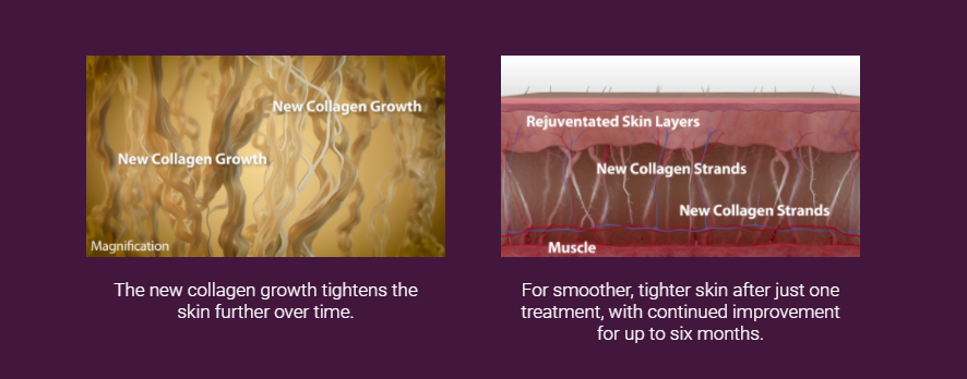 How Thermage works and its results