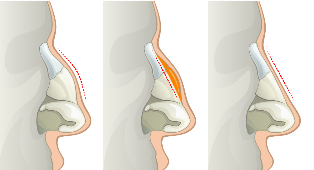 Hump reduction smooths the nasal bridge