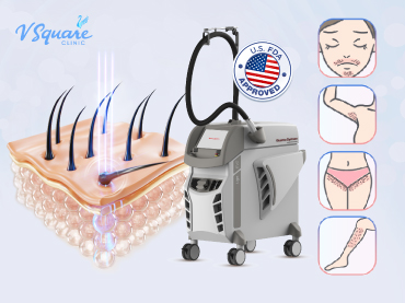 Laser Hair Removal 370x277