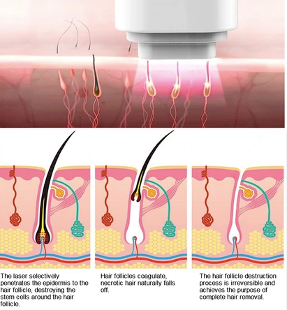 Laser Hair Removal how it works