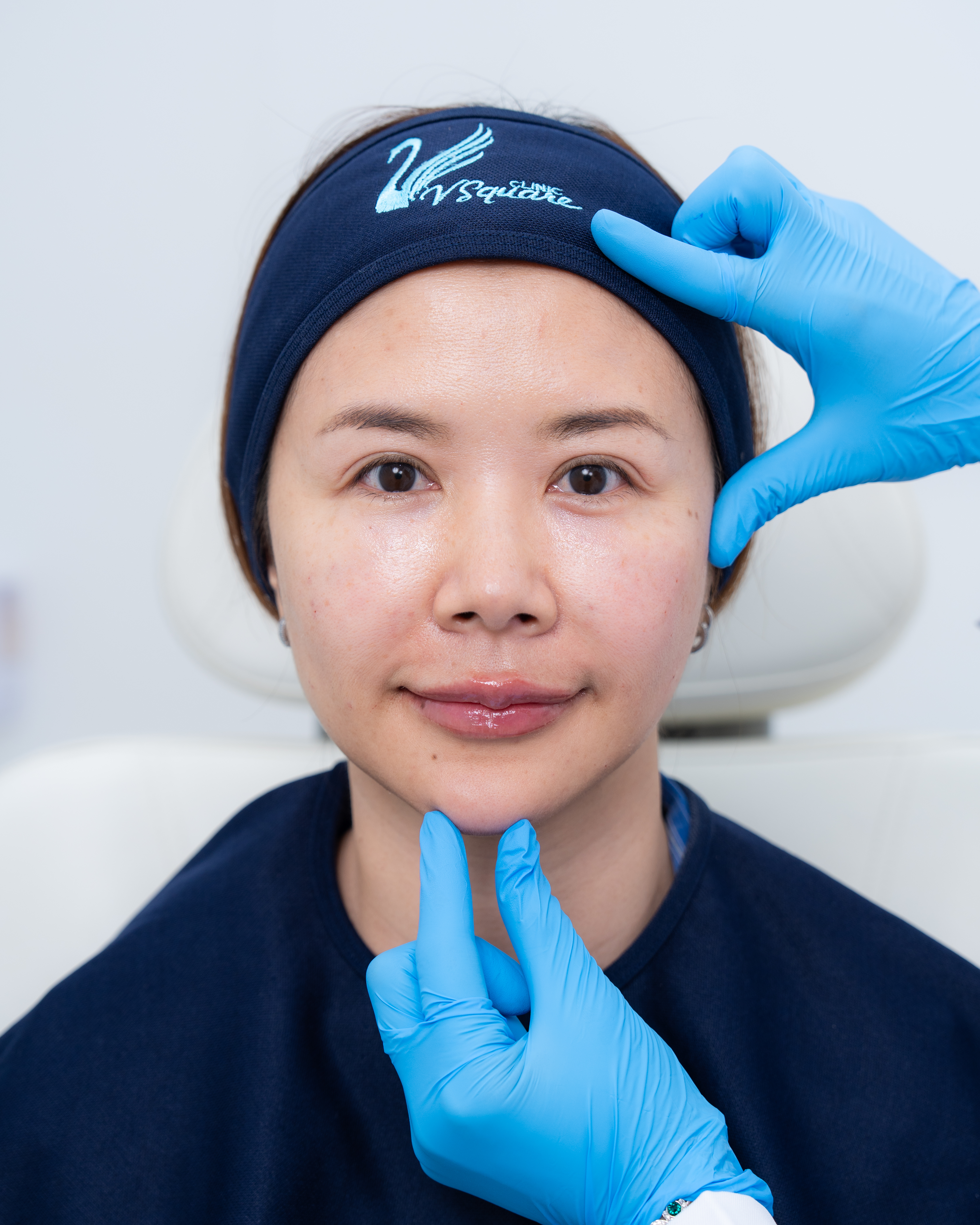 Lip injection with Restylane Kysse