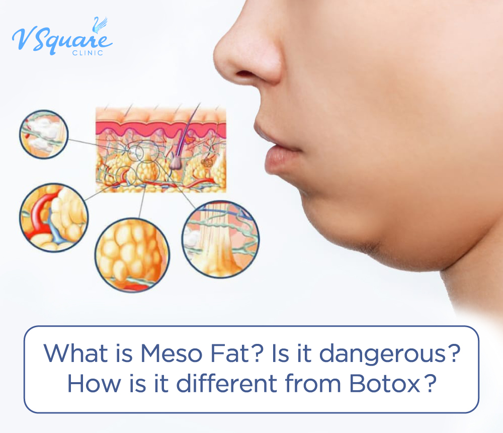 Meso Fat injection