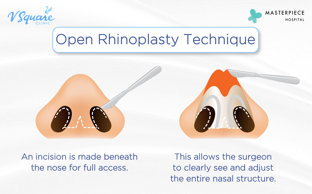 Open rhinoplasty technique