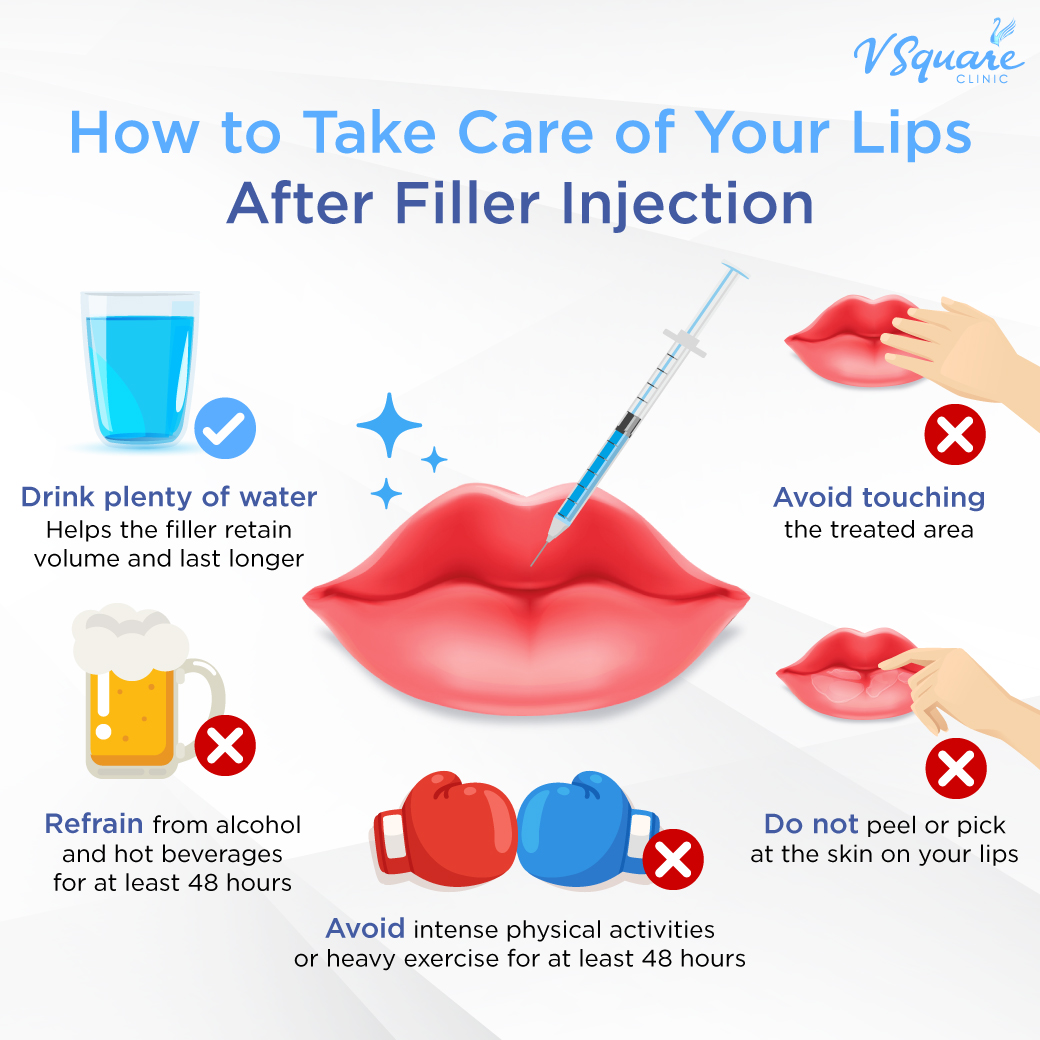 Post-treatment care after Restylane Kysse injection