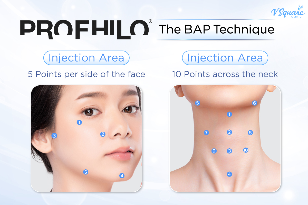 Profhilo BAP Technique