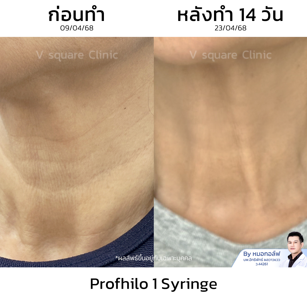 Profhilo neck review_พี่ต่าย