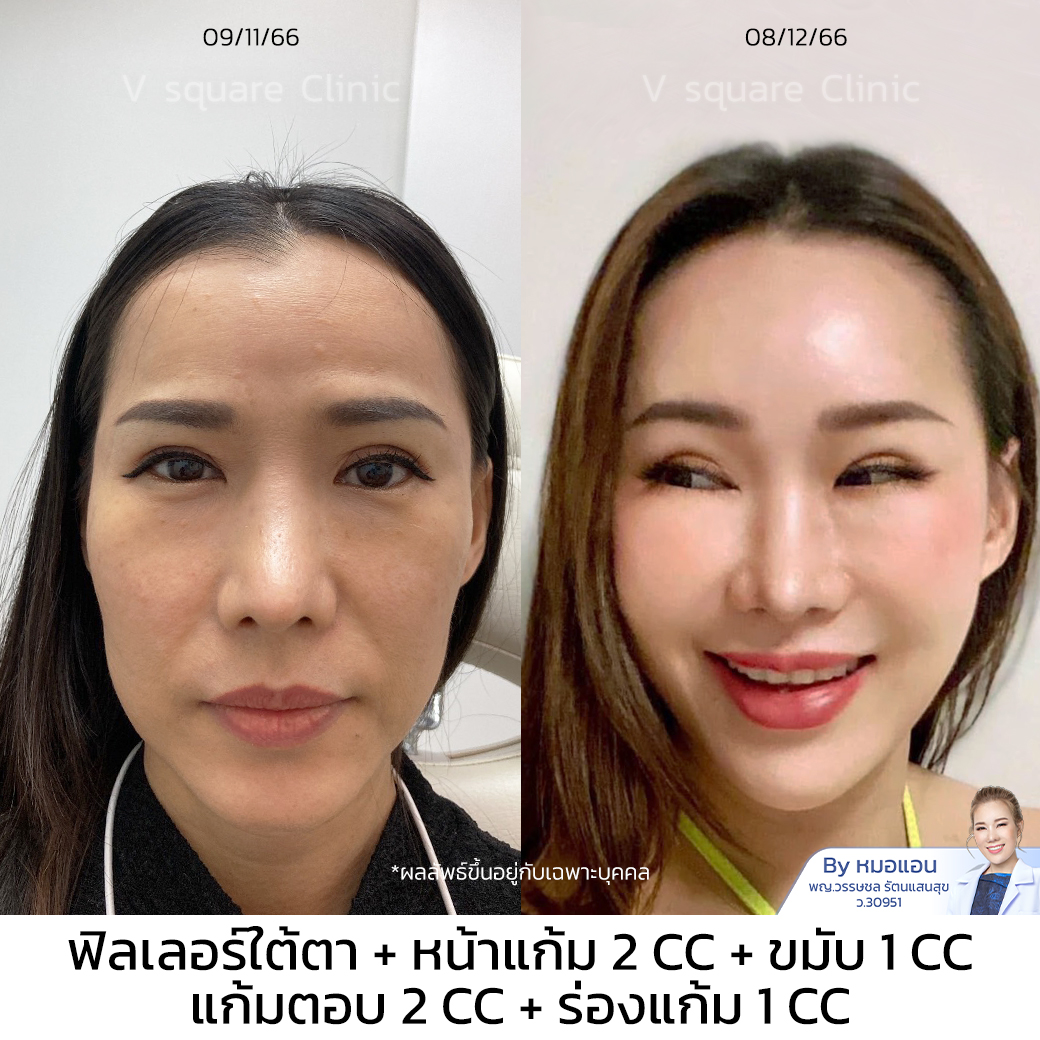 Restylane Filler review_คุณพิมพ์นิภา