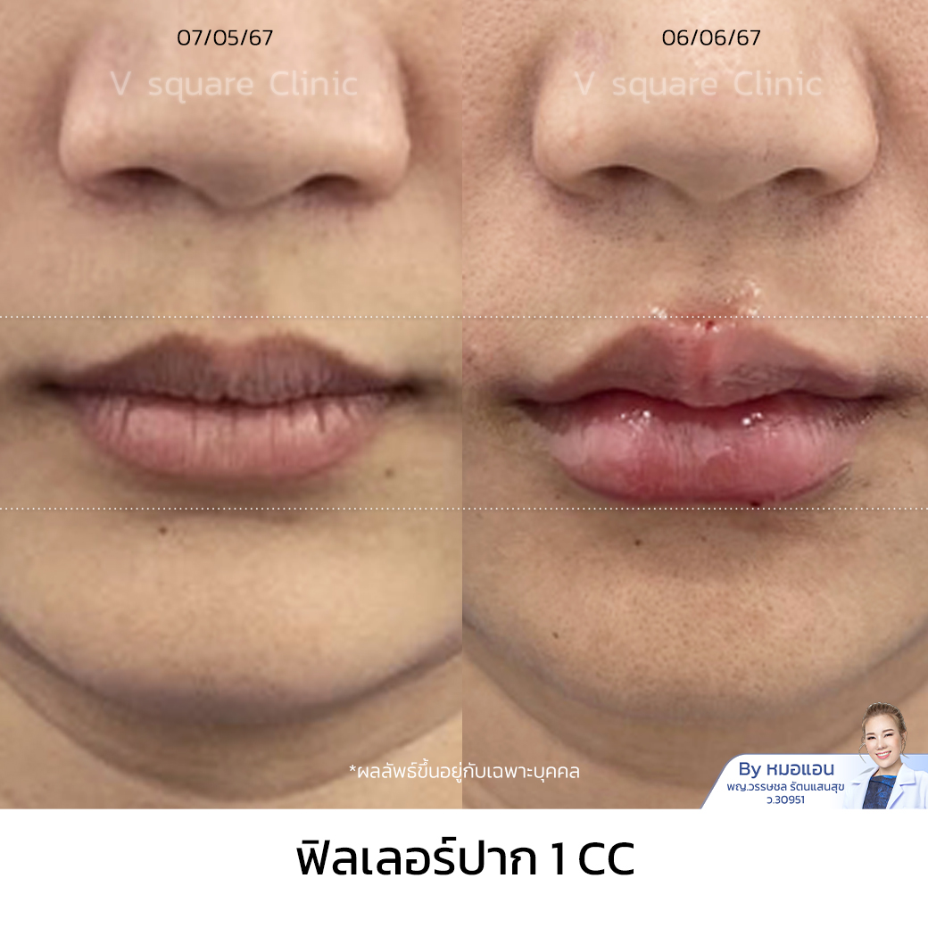 Review Restylane Kysse Filler 1 CC_คุณกมลชนก