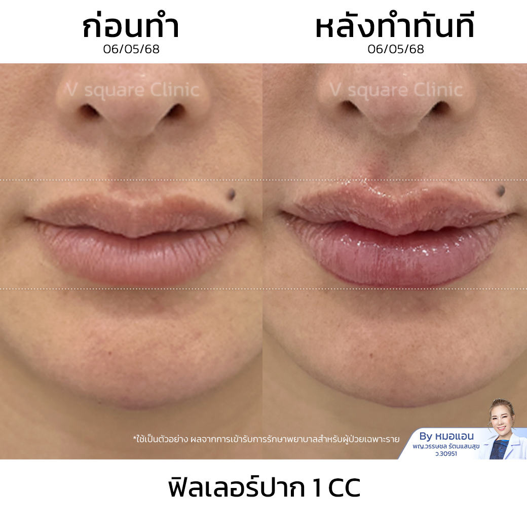 Review Restylane Kysse Filler 1 CC_ส้ม