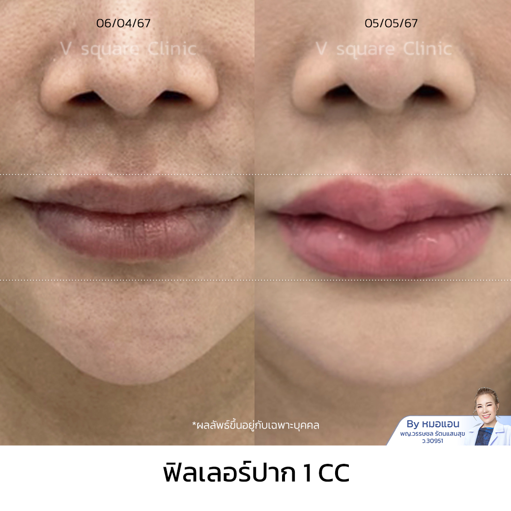 Review Restylane Kysse Filler 1CC_คุณเขมิสรา