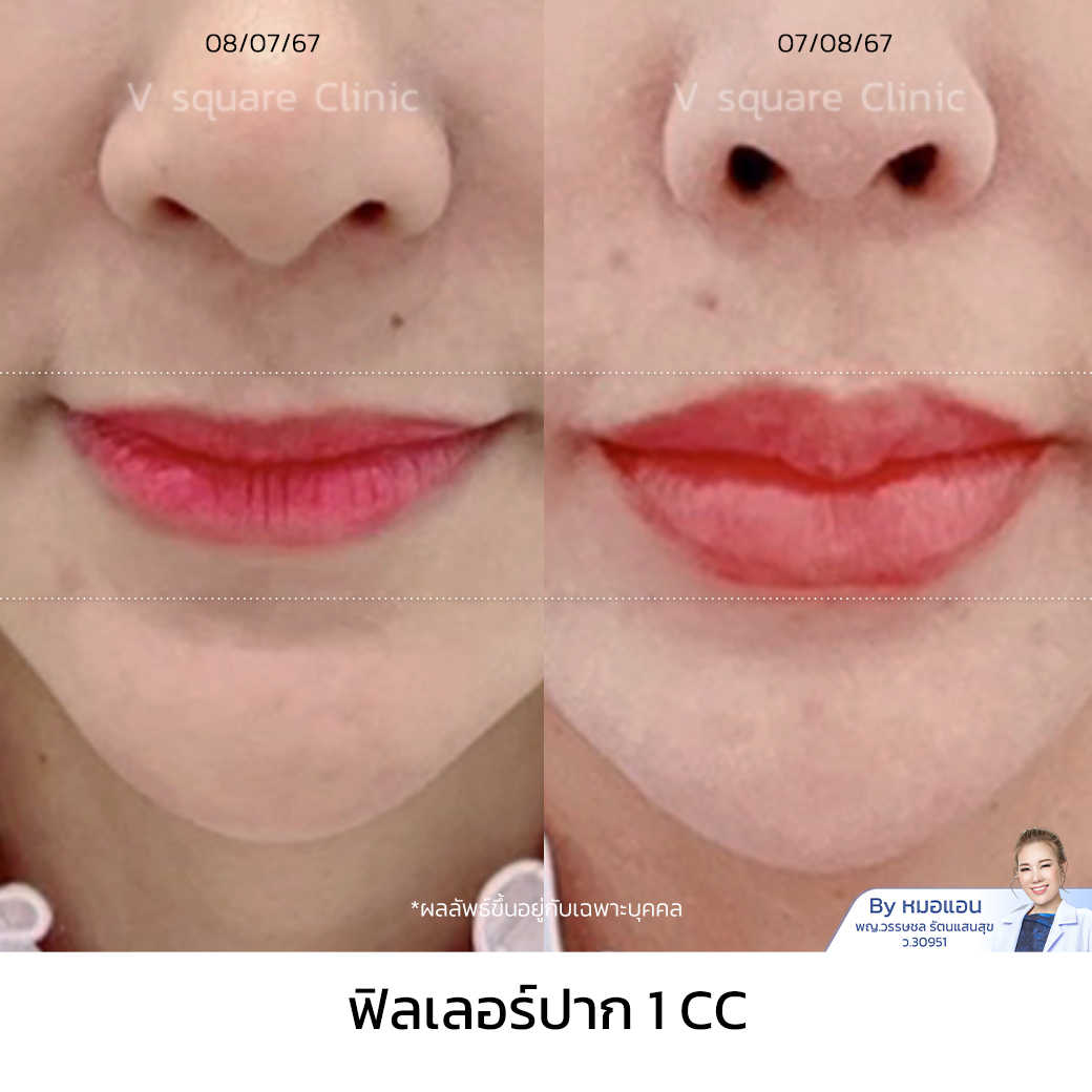 Review Restylane Kysse Filler1CC_คุณณัฐญาดา