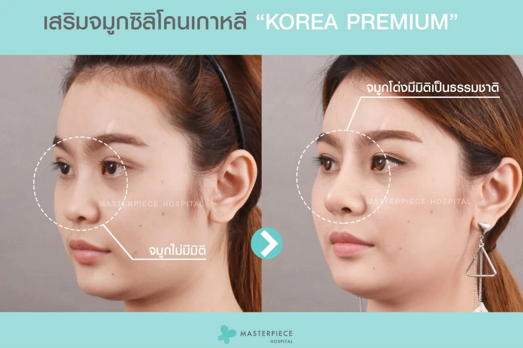 Rhinoplasty enhances facial definition and dimension