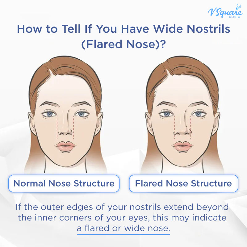 Rhinoplasty with alar base reduction