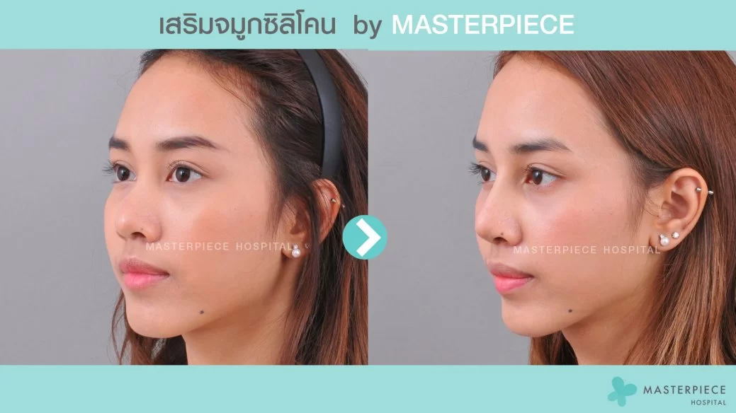 Rhinoplasty with silicone implants(1)