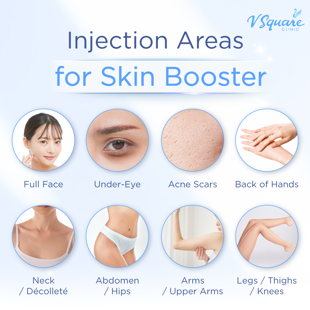 Skin Booster Injection Areas