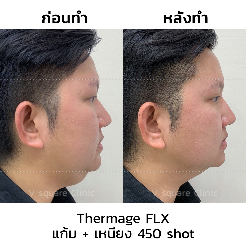 Thermage flx review_ต๊อก
