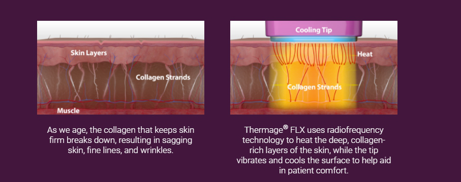 Thermage helps reduce sagging and fine lines