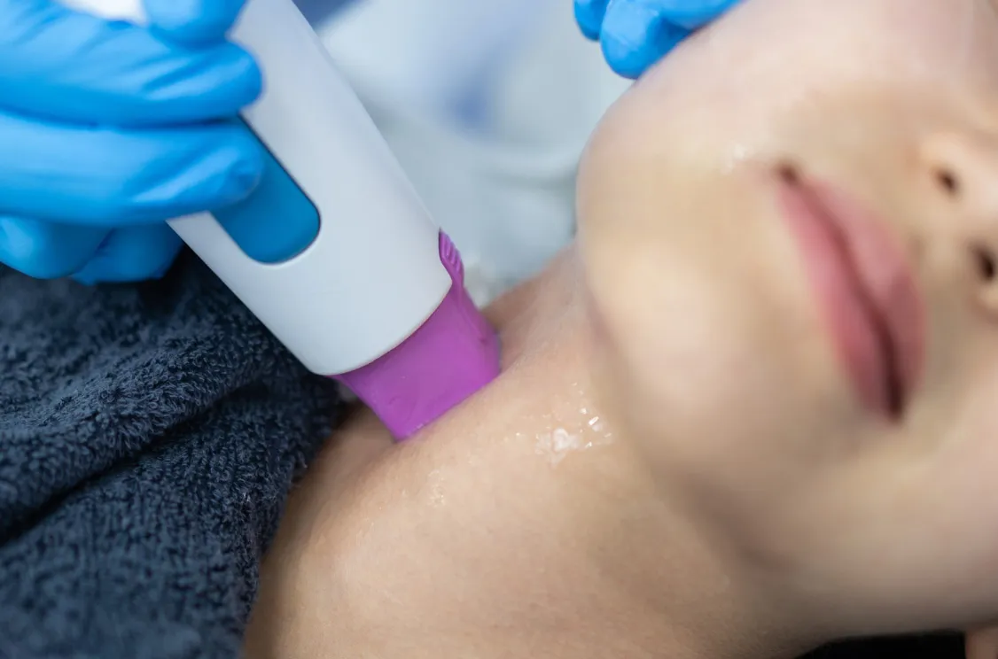 Thermage on the neck