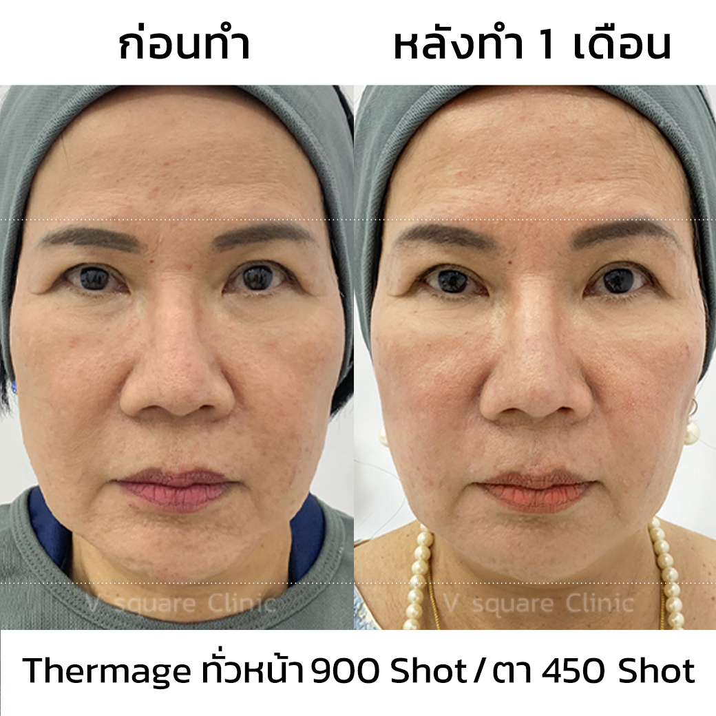 Thermage review_แม่อ๋อย