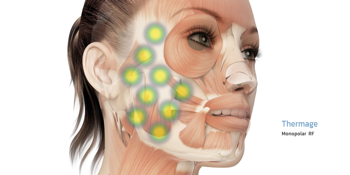 Thermage’s heat distribution pattern