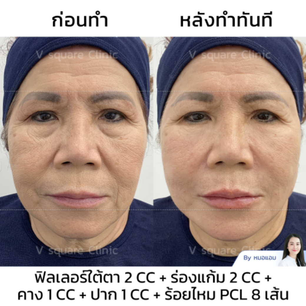 Thread Lift Review_คุณหมวย by Dr.Kornkanok