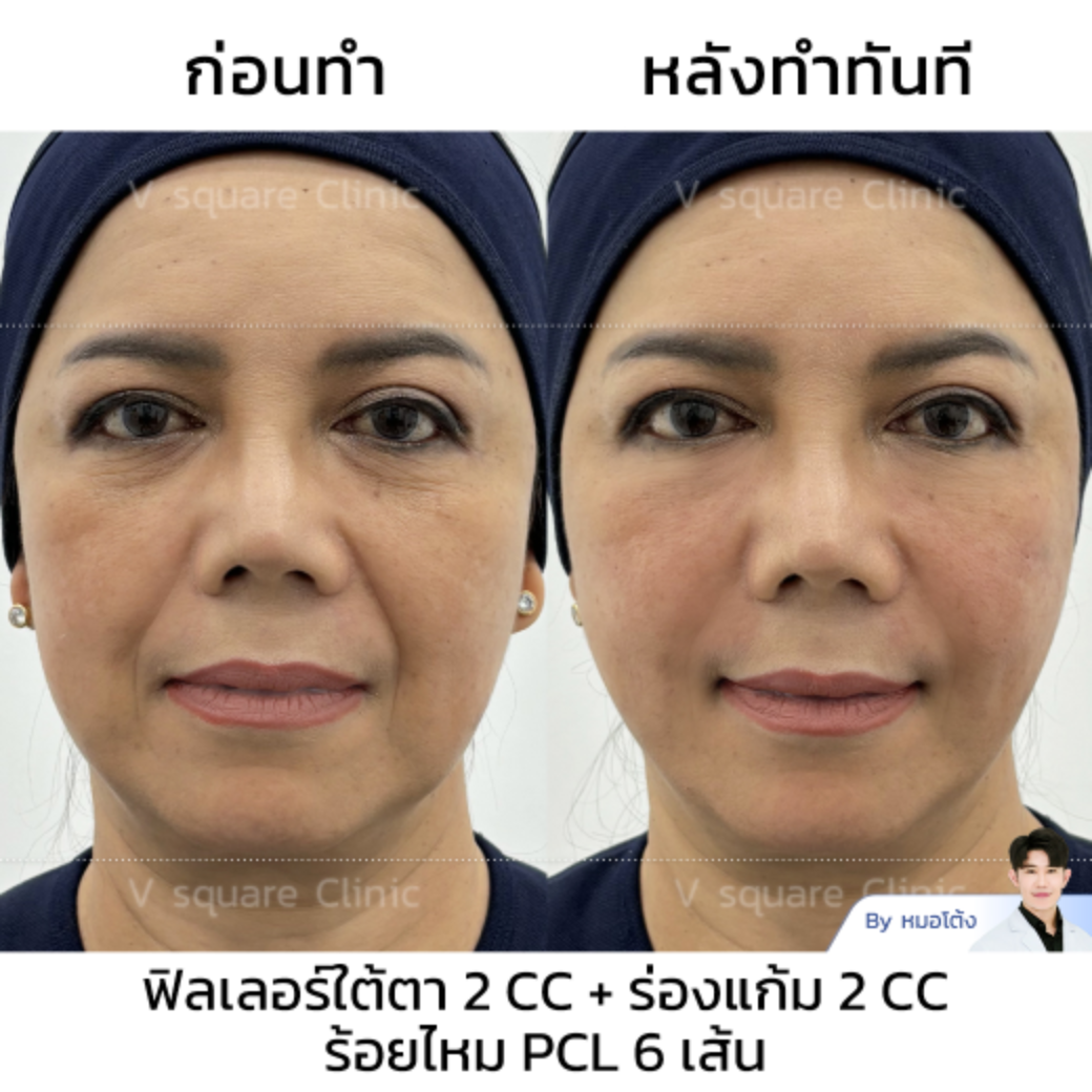 Thread Lift Review_แม่เปิ้ล Influencer by Dr.Sittinun