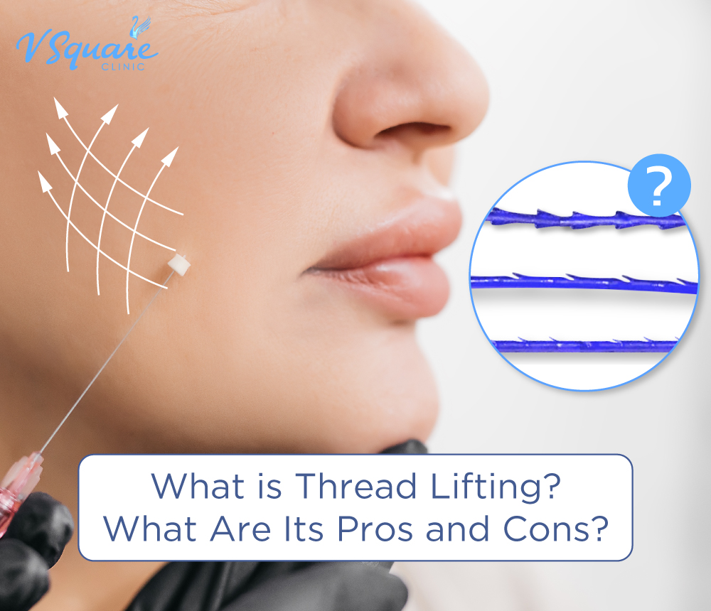 Thread Lifting