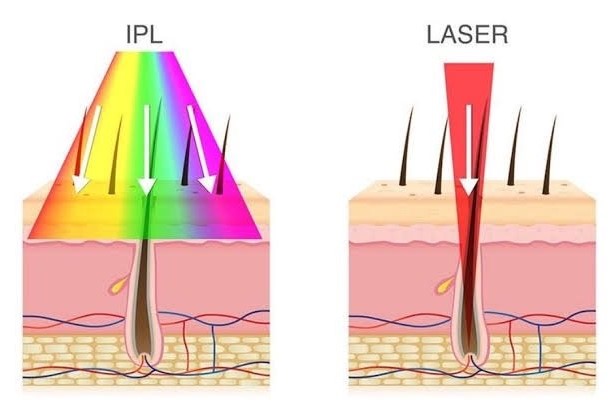 Type of Laser Hair Removal
