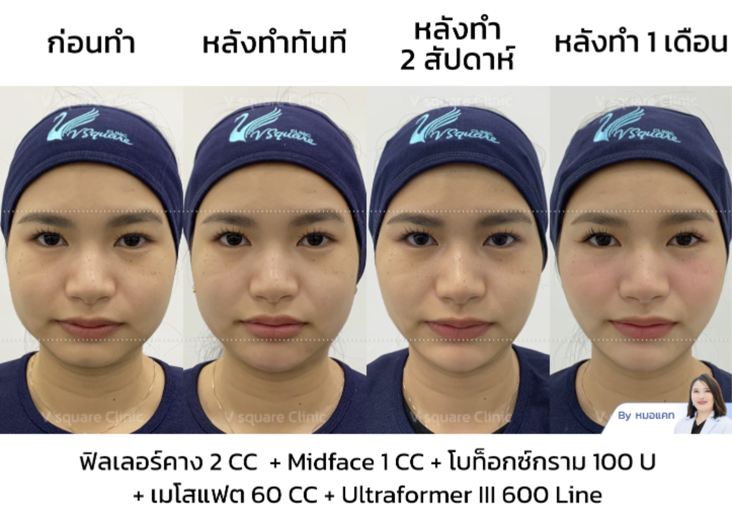 jawline contouring botox_คุณเนย