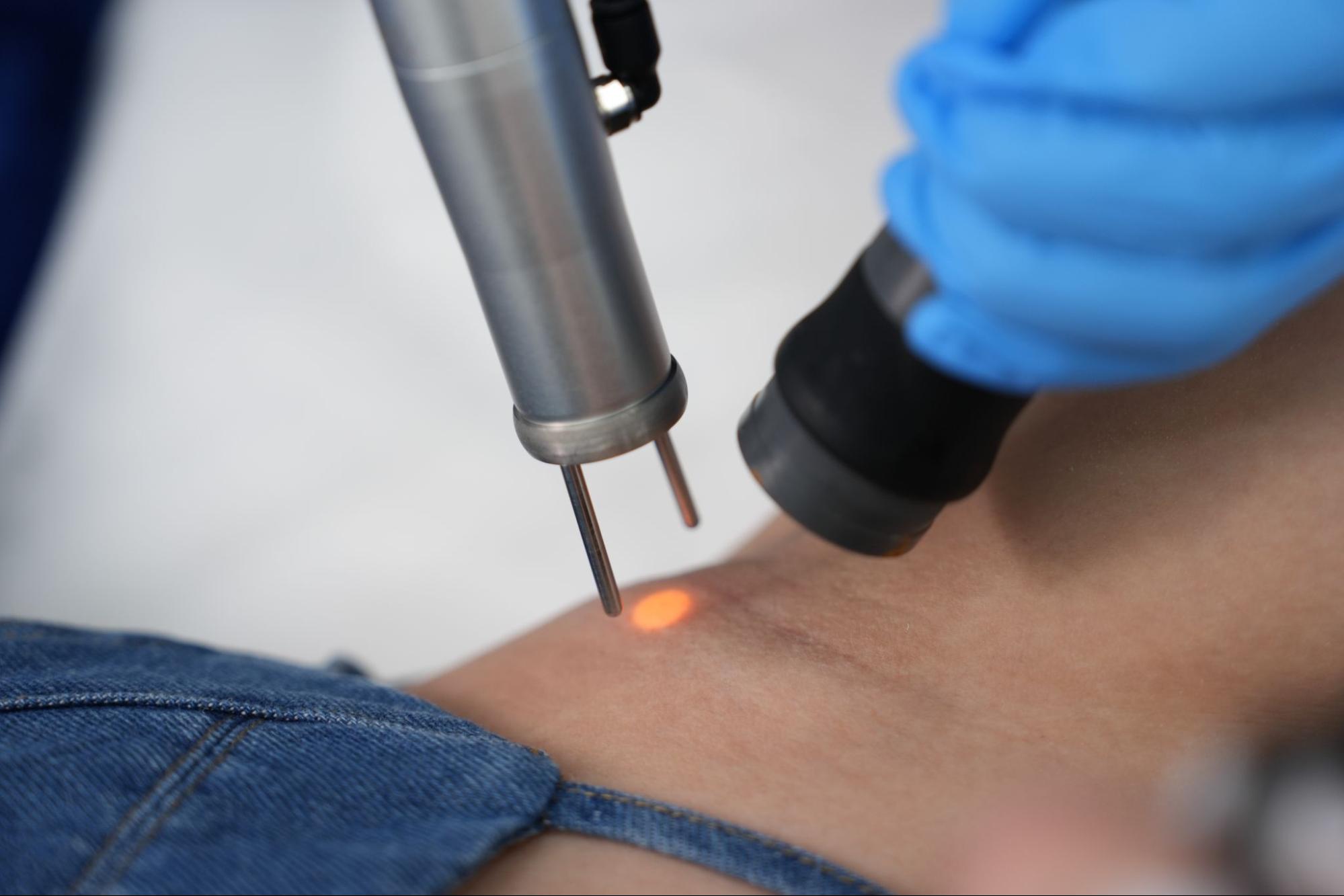 laser armpit hair removal