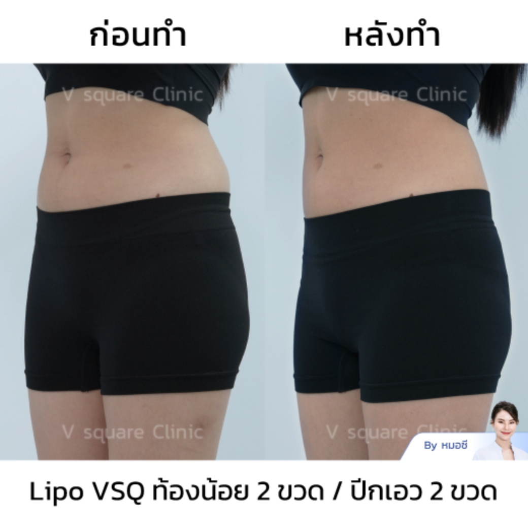 meso fat stomach_คุณปาร์ม