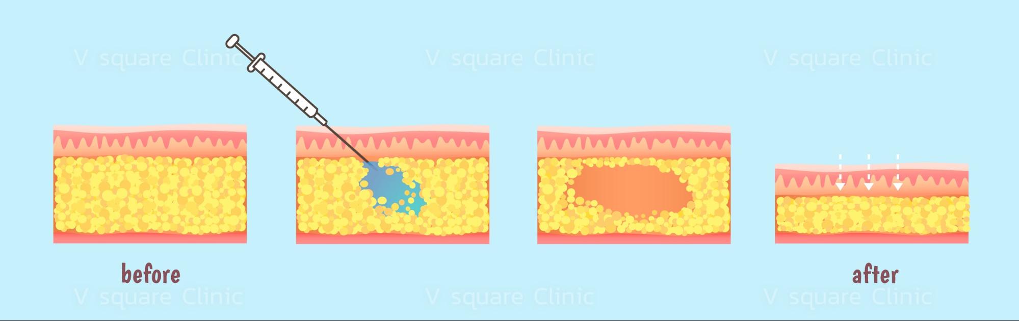 mesofat, how it works