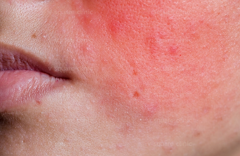 Allergic reaction from unapproved vitamin injection