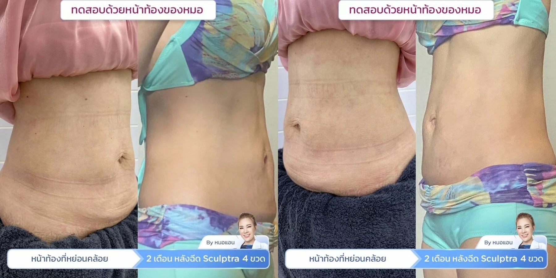 Review Sculptra Body โดย Dr.Watsachon Rattanasansuk ว.30951