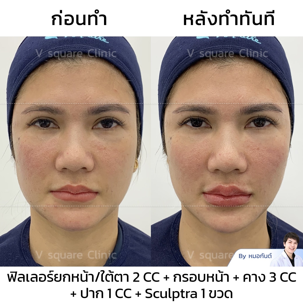 Sculptra Review_ทนายนิด้า โดย Dr. Kant Suwanrat ว.35257
