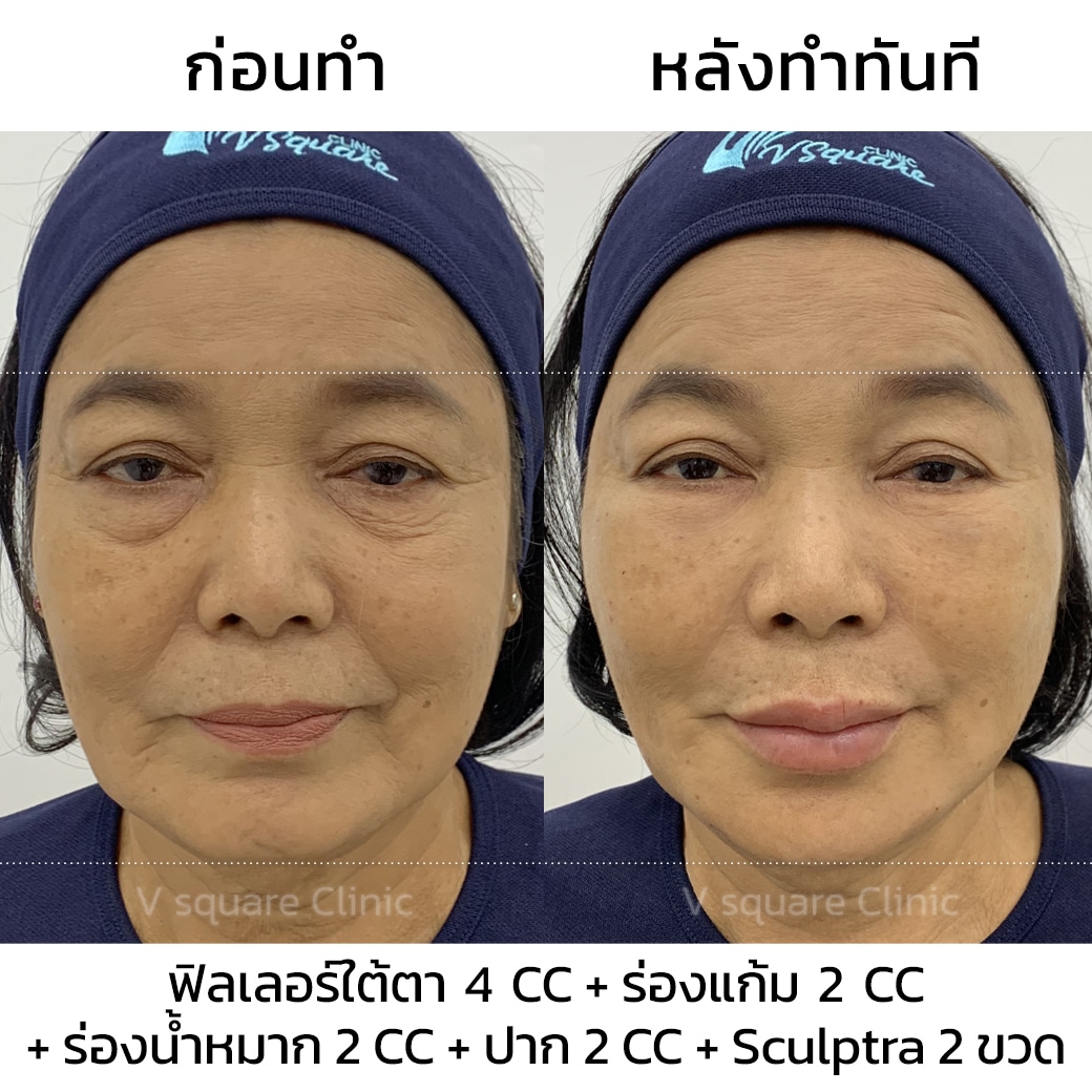 Sculptra Review_แม่แรม