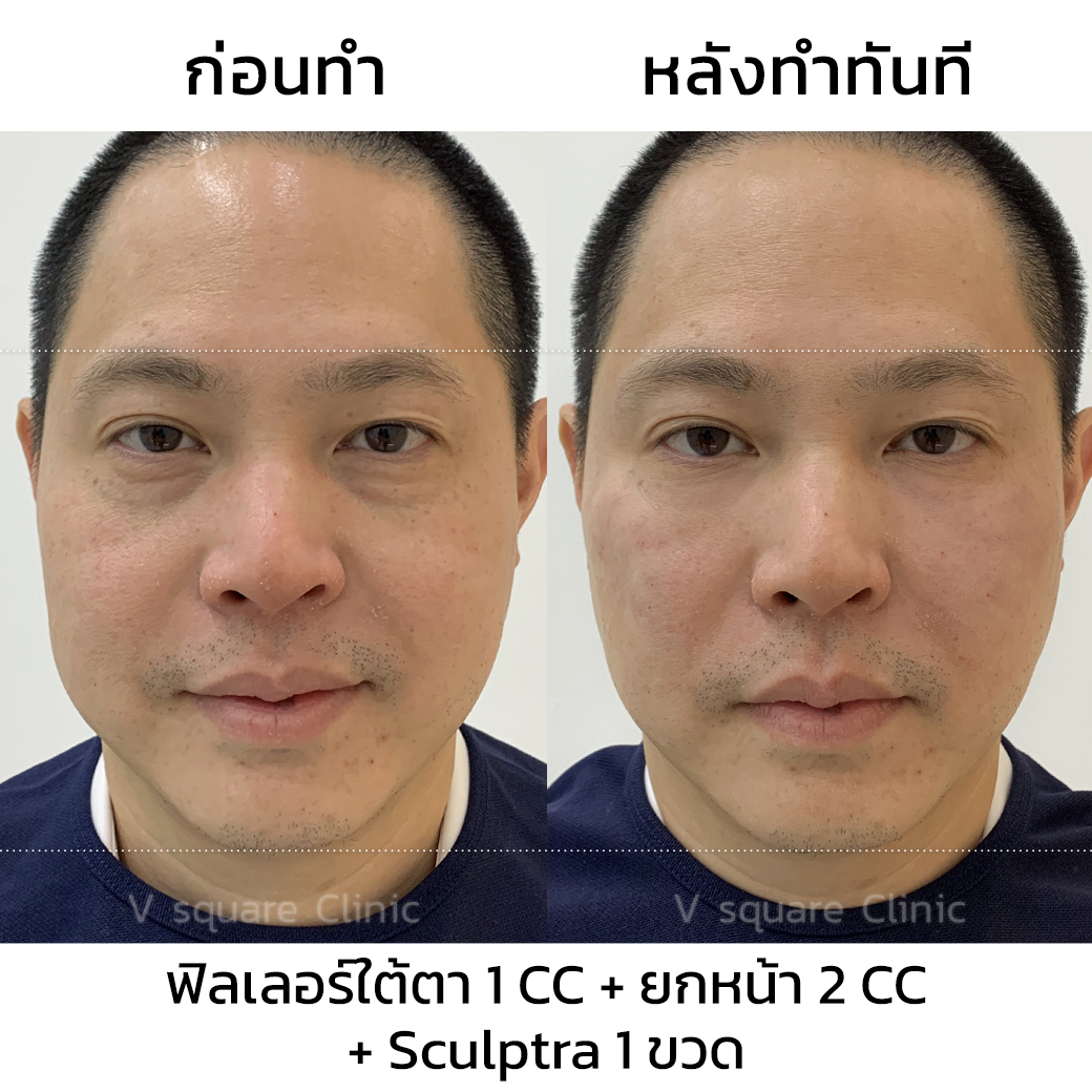 review Sculptra_หมอเส