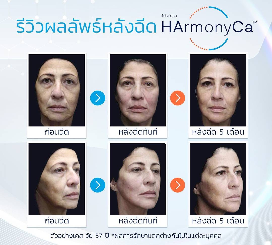 HArmonyCa injection review