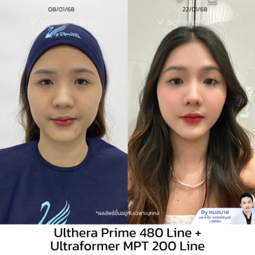 Review Ulthera Prime_เอิร์น UL RR+MPT by Dr.Satit Panichpibool
