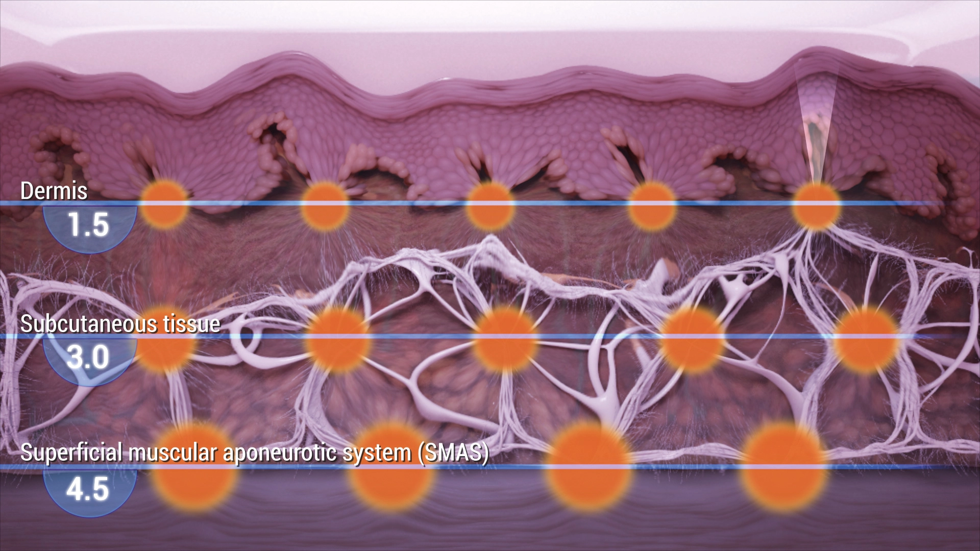 ULTHERA SPT+ lifting SMAS layer