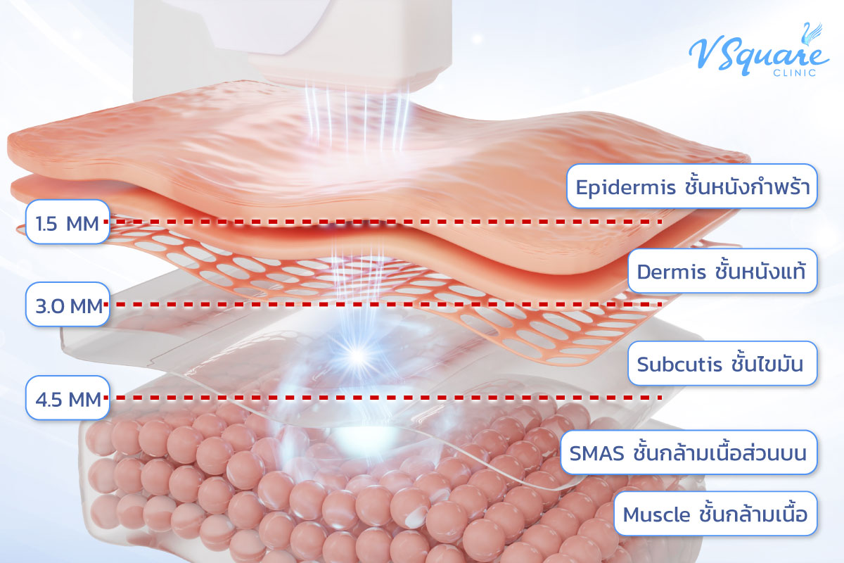 Ulthera Prime procedure process