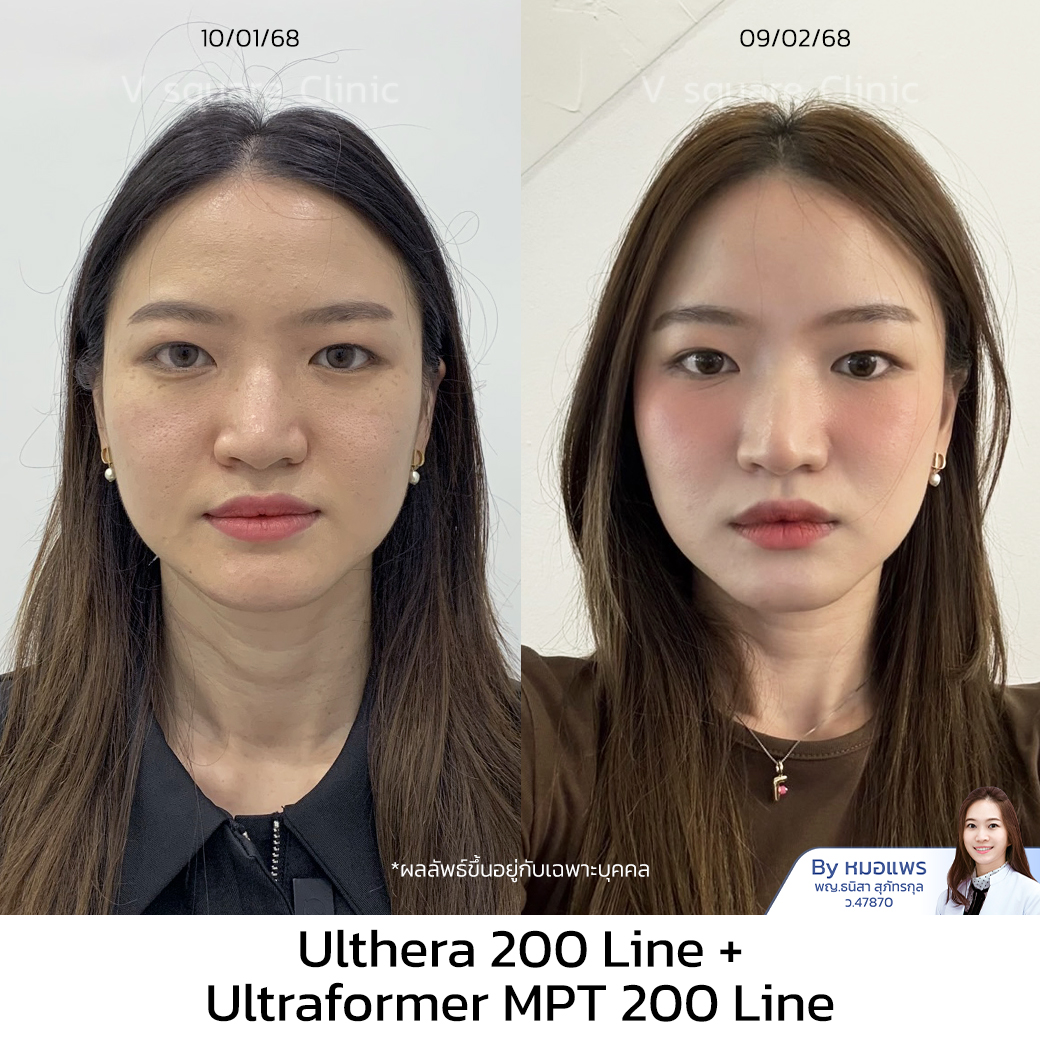 Ultherapy Prime review_ฟิว โดย หมอ แพร